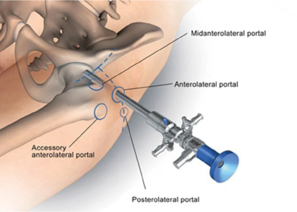 Artroscopia do quadril (ATQ) | Dr. Fernando Ferro | Cirurgia do Quadril em Goiânia