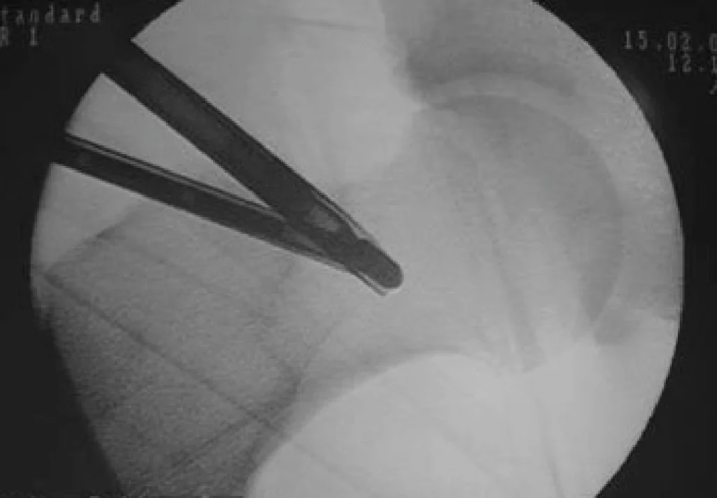 Artroscopia do quadril (ATQ) | Dr. Fernando Ferro | Cirurgia do Quadril em Goiânia