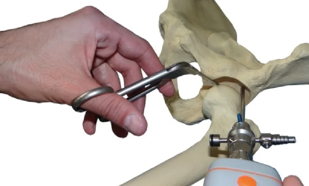 Artroscopia do quadril (ATQ) | Dr. Fernando Ferro | Cirurgia do Quadril em Goiânia