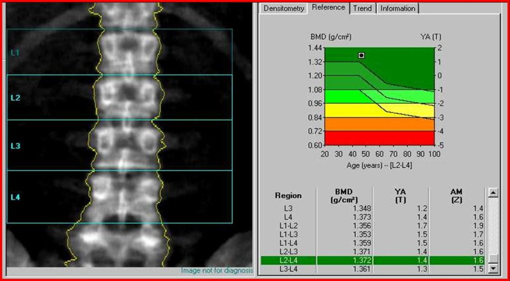 Osteoporose | Dr. Fernando Ferro | Cirurgia do Quadril em Goiânia