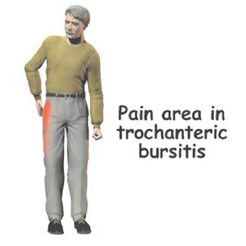 Anatomia da região trocantérica mostrando tendões e bursas do quadril